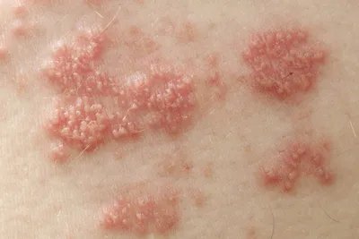 Фолликулит - Консультация Дерматолога Онлайн iDerma