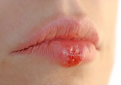 Обнаружила на половой губе уплотнение: причины, симптомы и способы лечения