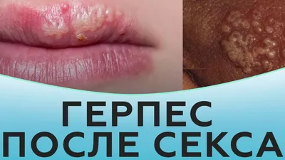 Лекарство от герпеса на губе: самое эффективное средство | Dental Art