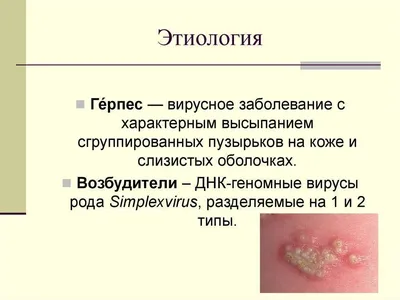 Лечение полового герпеса | МЦСМП — Международный центр скорой медицинской  помощи