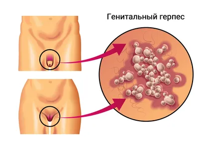 Генитальный герпес на половых органах у мужчин и женщин, лечение, симптомы