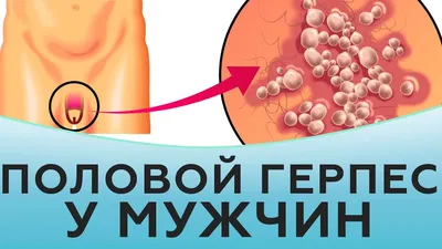 Герпес - симптомы, диагностика и лечение в клинике Universum Clinic