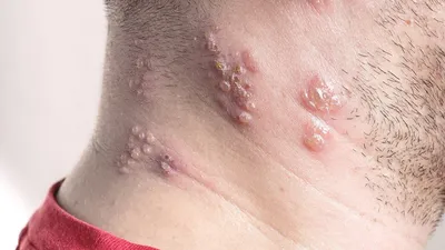 Инфицированная Кожей Вирус Herpes Zoster Вирус Герпеса На Теле Крапивница  Атопический Дерматит На Теле — стоковые фотографии и другие картинки  Опоясывающий лишай - iStock