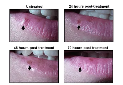 Герпес — Derma.ua