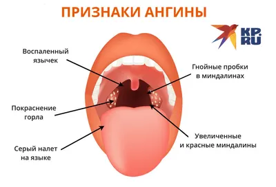 Лечение ангины гомеопатией / Центр Гомеопатии / Статьи