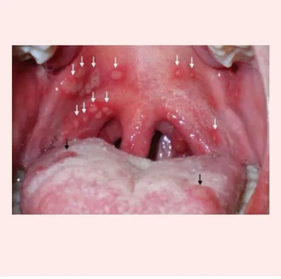 Гепрангина (герпесная ангина) - симптомы, лечение у детей и взрослых