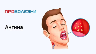 Лаборатория Бонецкого - ⠀⠀⠀⠀⠀⠀⠀⠀ Герпетическая ангина – один из видов  вирусной инфекции, который особенно часто поражает людей в осенний и  весенний период. ⠀⠀⠀⠀⠀⠀⠀⠀ Также это заболевание известно как, герпангин,  герпетический тонзиллит ...