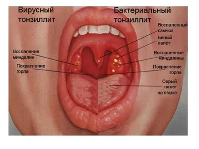 Ангина: причины, симптомы и лечение в статье инфекциониста Александров П. А.