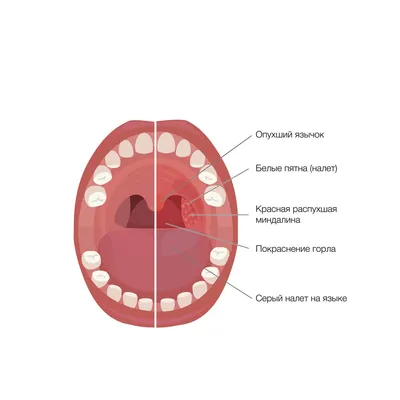 Герпесная ангина у детей: причины, симптомы и профилактика - РИА Новости,  18.12.2020
