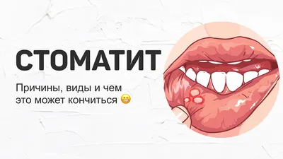 Все виды стоматита и их лечение - афтозный и герпетический стоматит