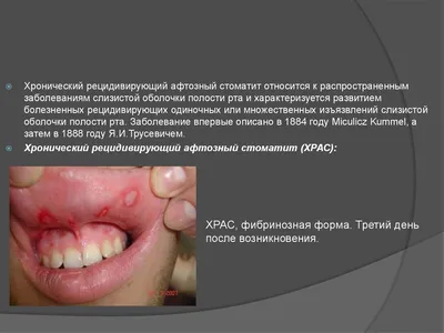 Стоматит у детей: виды и лечение | Healthy Dent (Киев)