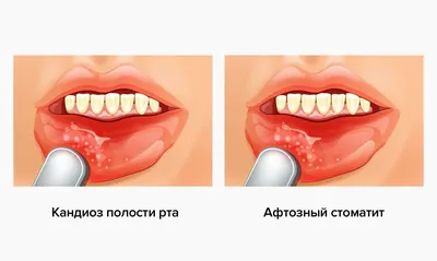 Стоматит у детей: причины, симптомы, лечение