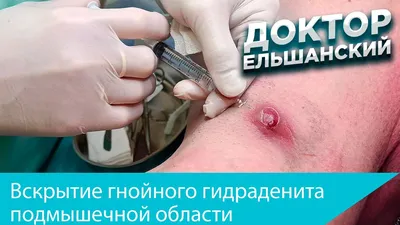 Гидраденит 👾 ⠀ Название-то какое... - Студия красоты Pion | Facebook