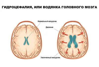 Гидроцефалия: симптомы, причины, диагноз и лечение