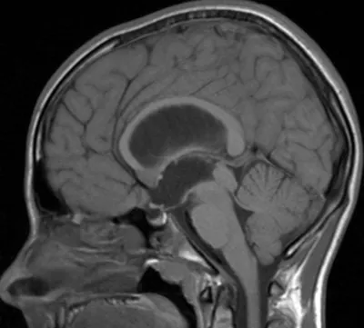 Гидроцефалия головного мозга на МРТ