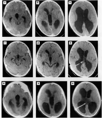 Наружная гидроцефалия головного мозга у взрослого: диагностика и лечение в  Москве
