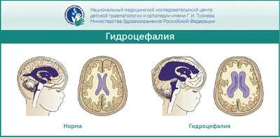 Что такое гидроцефалия, из-за чего рождаются дети с увеличенным черепом и  как лечат гидроцефалию нейрохирурги НИКИ педиатрии? .. | ВКонтакте