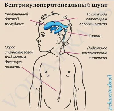 Гидроцефалия головного мозга - Нейрохирург в Тольятти