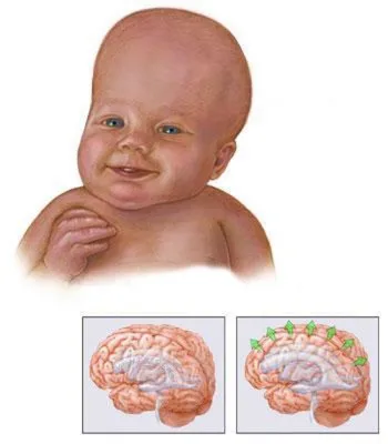Гидроцефалия у детей - признаки, причины, симптомы, лечение и профилактика  - iDoctor.kz