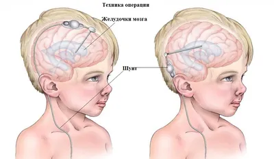 Гидроцефалия и другие неврологические осложнения у детей со Spina bifida