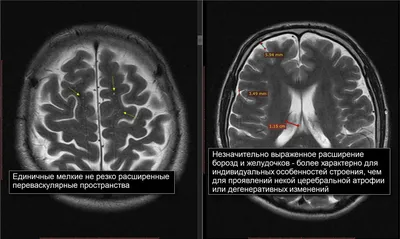 Как снизить риск гидроцефалии? | Институт Мужского Здоровья (Томск) ::  Клиника для Мужчин