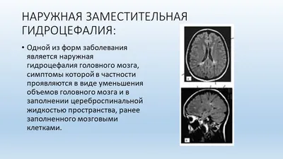 Лечение гидроцефалии головного мозга в Екатеринбурге - Новая Больница