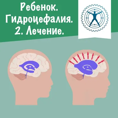 Гидроцефалия» — Яндекс Кью