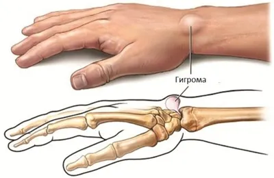 Гигрома: на кисти, запястье, руке; на ноге, стопе, фото, лечение