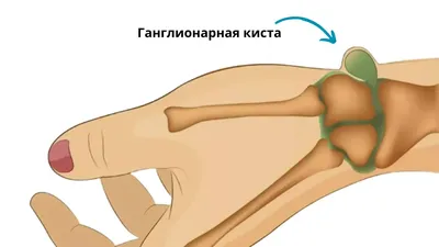 Гигрома. Каждый может попасть на операцию. - ЯПлакалъ