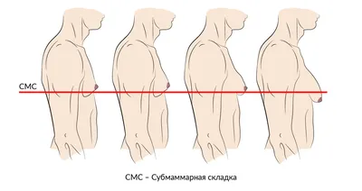 Гинекомастия