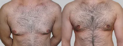 Наша работа. Фото до и после — Лечение гинекомастии у мужчин