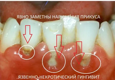 Гингивит – симптомы, разновидности, лечение, профилактика