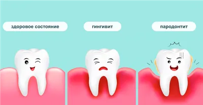 Гингивит- причины, виды гингивита, его осложнения и лечение