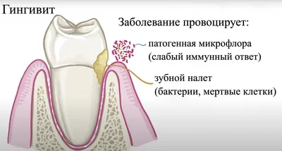 Симптомы гингивита у детей, цена лечения в Москве