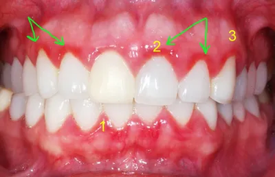 Хронический катаральный гингивит - Cтоматология Май