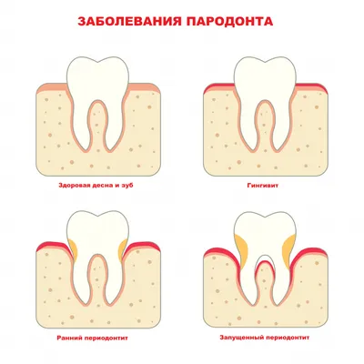 Что такое Гингивит, симптомы и лечение Гингивита | Профилактика гингивита