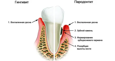 Болезни десен - гингивит - - Стоматология СмайлДент в Красноярске