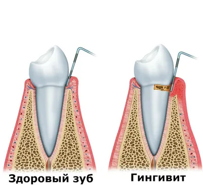 Гингивит - воспаление дёсен