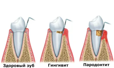 ГИНГИВИТ – причины воспаления десен, симптомы и лечение