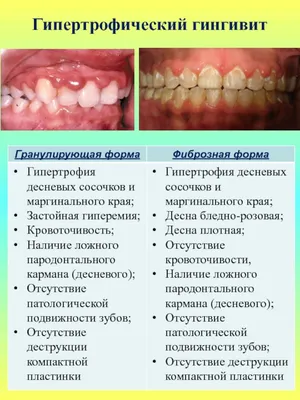 Гингивит - симптомы, виды и лечение у взрослых и детей