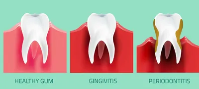 Хронический катаральный гингивит - форум Стоматология.Су
