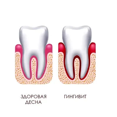 Гипертрофический гингивит план лечения - 82 фото