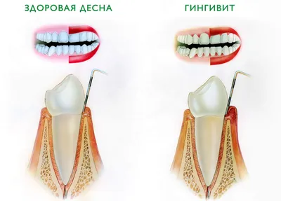 32 Margarit Dental Clinic - Гипертрофический гингивит, симптомы и лечение.  Гипертрофическим гингивитом называют такое хроническое воспаление десны,  которое сопровождается реактивным разрастанием волокнистой соединительной  ткани и базальных клеток ...