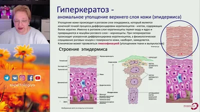 С чем связано утолщение кожи на пятках? Лечение и профилактика гиперкератоз