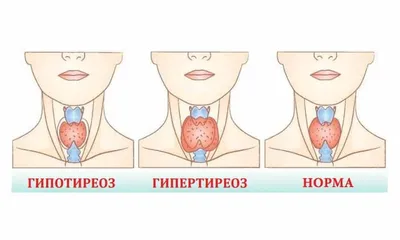 Гипертиреоз | Центр китайской медицины ДАМАО