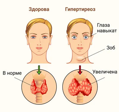 Гипертиреоз Иллюстрация Показывающая Женщину Болезнью Грейвса Известной  Токсичный Диффузный Зоб стоковое фото ©katerynakon 444822324