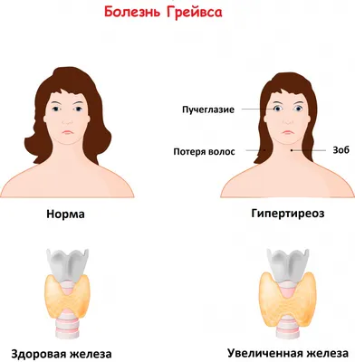 СТОП ОПАСНОСТЬ ❌ Гипертиреоз ⠀ * это личная мои наблюдения. Моя статистика.  Об это вам не скажут официальные источники. ⠀ Сегодня обсудим… | Instagram