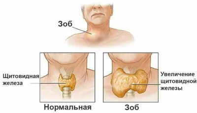 ГИПЕРТИРЕОЗ (ПОВЫШЕННАЯ АКТИВНОСТЬ) Термином гипертиреоз обозначают