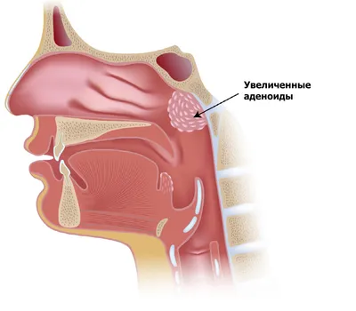 Аденоиды у детей: причины, симптомы и методы лечения | Klinik.by - Клиника  в Уручье