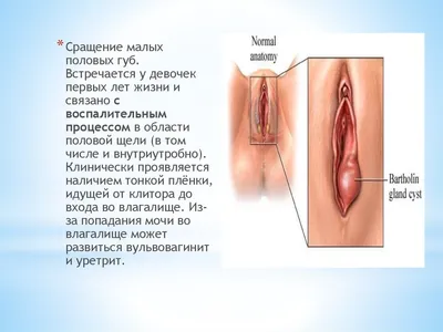 Лабиопластика - цена операции по пластике больших и малых половых губ в  Москве | АльтраВита